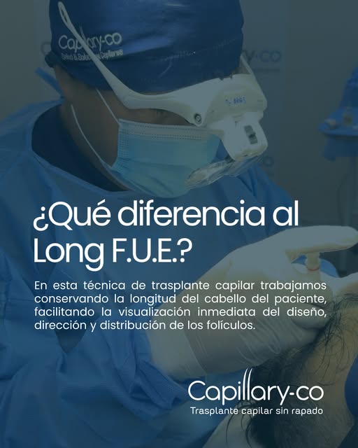 La técnica de trasplante capilar Long F.U.E. permite trabajar con el cabello largo, facilitando la v