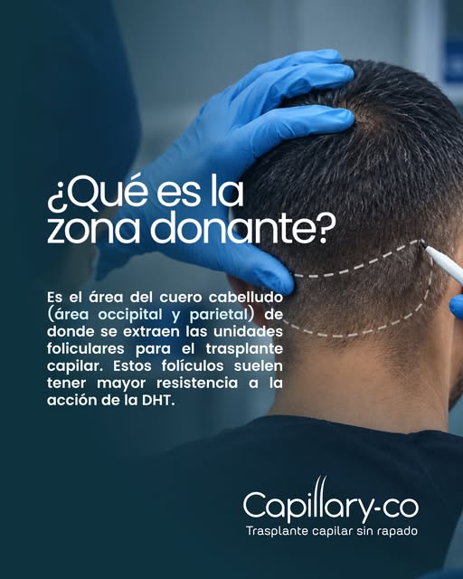 La evaluación de la zona donante es fundamental para determinar cuántos folículos pueden extraerse y