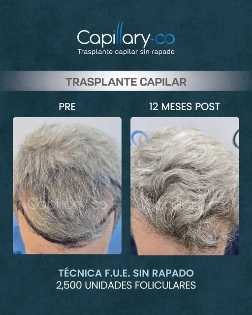 ¡Recupera tu cabello sin raparte!

🔹Megasesión de 2,500 unidades foliculares 
🔹Técnica: F.U.E. sin