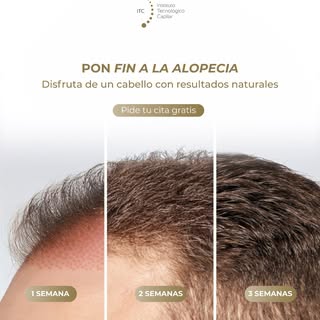 ¡DEJA DE ESPERAR O PIERDE TU PELO! 🛑⏰

Cada mes que dejas pasar ignorando los clareos o la caída, s