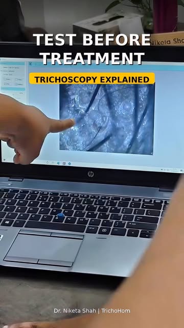 Not every hair fall needs same treatment!

This is why Trichoscopy is NON-NEGOTIABLE before any hair