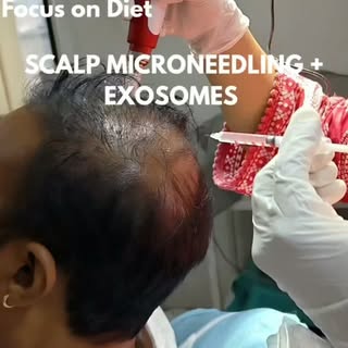 ✨ Microneedling + Exosomes: Why is this combination gaining attention?

What happens when microneedl
