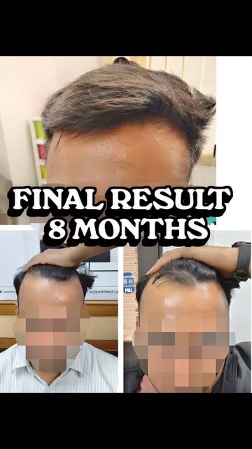 FUE Hair Transplant Result After 8 Months | 
Dense Natural Hairline Ahmedabad

From bald to bold - 2