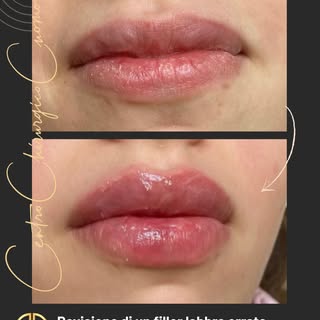 Un errore può capitare. Abbandonare il paziente no.
👄Revisione di un #filler labbra eseguito con te