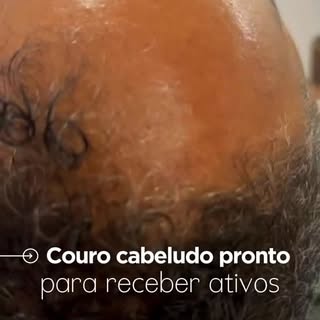 Couro cabeludo preparado para o microagulhamento biológico (sem agulhas). Você já conhece?

Esse pro