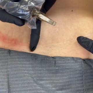 Inkless Scar & Stretch Mark Camouflage — a natural approach to restoring skin tone and confidence in