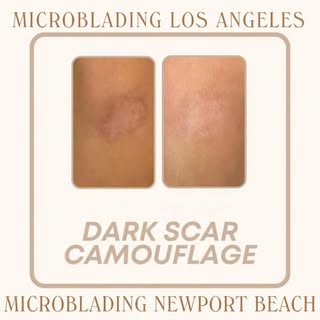 PARAMEDICAL TATTOO
Dark Scar Camouflage ❤️‍🩹

Restore confidence and even out skin tone with advanc
