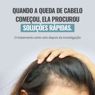 A queda de cabelo feminina é uma queixa comum, mas nem sempre tem a mesma origem. 

Ela pode estar r