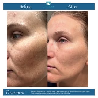 ✨ Before & After CoolPeel™ Magic! ✨ Witness the transformation! Tetra CO2 CoolPeel™ laser treatments