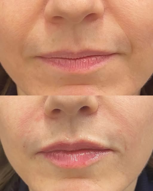 Some lips + smile lines filler to enjoy on this Labor Day. Gorgeous, rejuvenated, refreshed ✨. Hope 