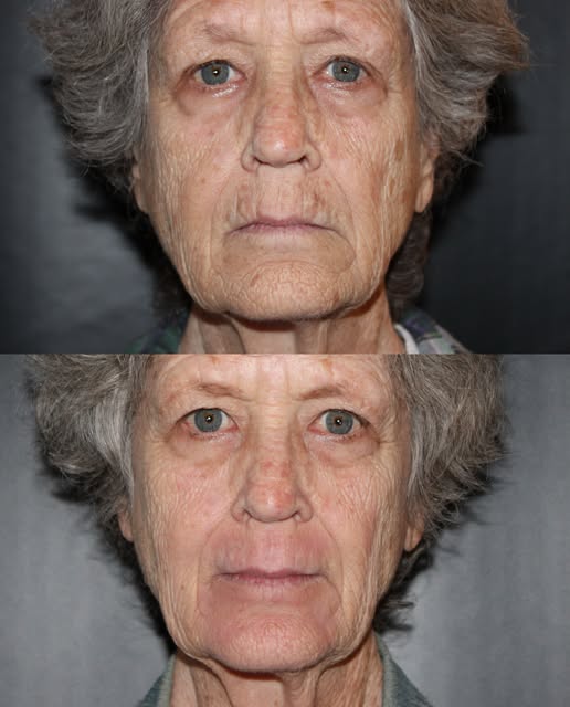 Deep phenol peel for perioral lines + TCA peel for remainder of face at 2 month results.

When it co