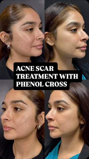 Acne scar treatment with phenol CROSS