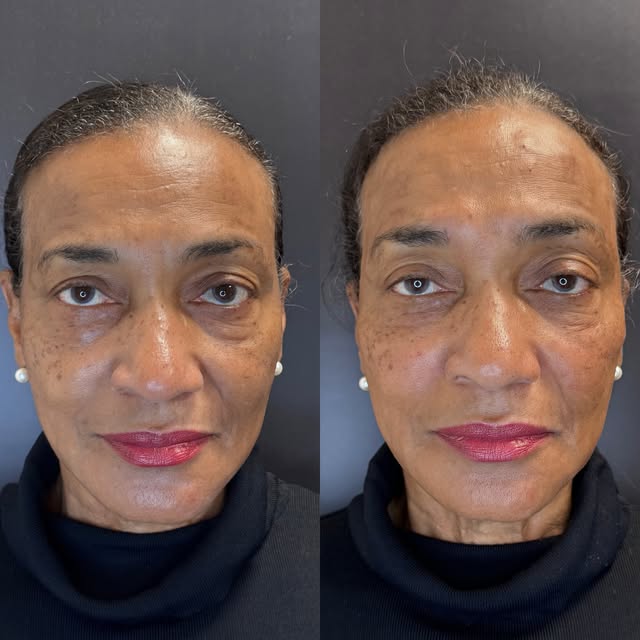 Full facial balancing ✨✨✨ this whole look achieved with hyaluronic acid fillers - any guesses to whi