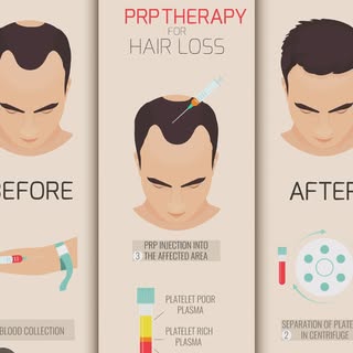 #hairlosssolution #prphairrestoration