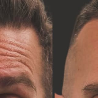 #botoxbeforeandafter