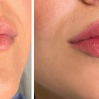 #lipfillerresults #revanesseultra