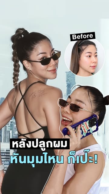 8 เดือนหลังปลูกผม 🗯️ จากแนวผมที่เคยบาง วันนี้กรอบหน้าดูเต็มและละมุนขึ้นแบบเห็นได้ชัด หลังปลูกผม #เม