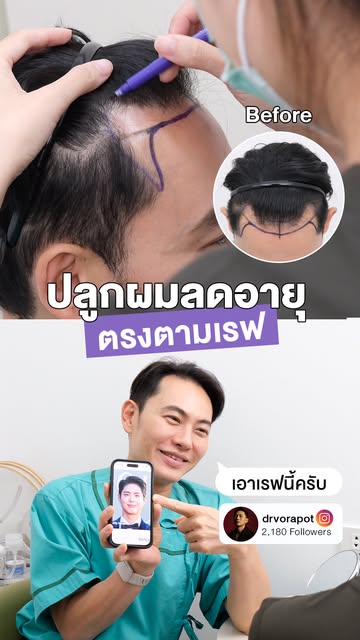 คุณหมอ'อาร์ม (คุณหมอฟิลเลอร์แห่ง @hertitude ) เลือกปลูกผมที่ #MediHair ด้วยเทคนิค Non-Shaven FUE
เพื