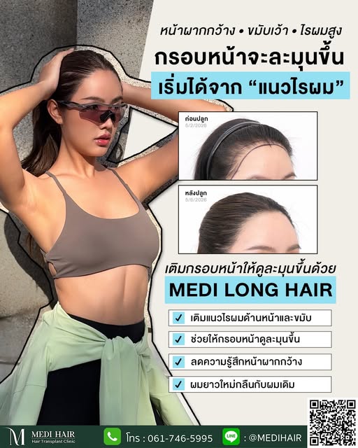 หัวเถิก แนวผมด้านหน้าสูง ขมับเว้า หรือหน้าผากดูกว้าง
🗯️ Medi Long Hair คือเทคนิคปลูกผมยาวทันที ที่ช