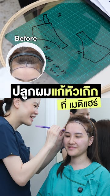 ปัญหาหัวเถิกแก้ได้ แบบไม่ต้องโกนผม! ✨
Non Shaven FUE เติมแนวผมบริเวณหน้าผากที่เว้า ให้กรอบหน้าดูเต็ม