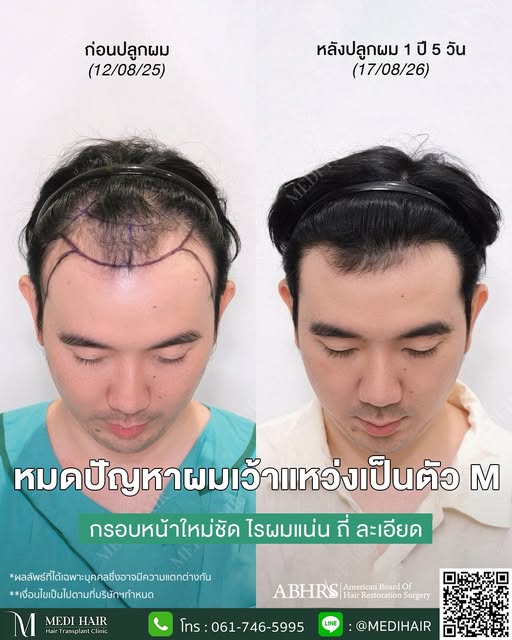 รีวิว 🗯️ เคสคุณผู้ชายปลูกผมด้วยเทคนิค Shaven FUE ที่ Medi Hair
ก่อนทำมีปัญหาแนวผมเว้าเป็นตัว M ร่วม