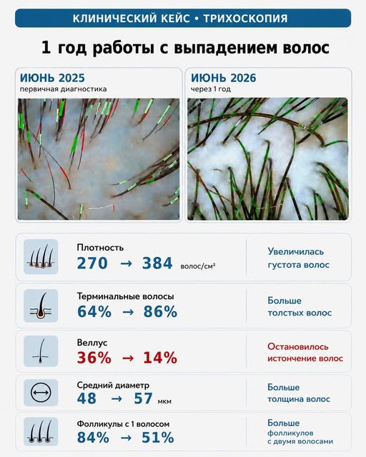 Клиентка 32 года обратилась ко мне год назад с очень сильным выпадением волос.
Вся квартира была усы