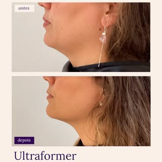 Olha esse resultado de Ultraformer 👀

Sabe aquela sensação de que o contorno do rosto "perdeu firme