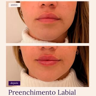Preenchimento Labial com resultado delicado 💋

Agende sua avaliação 
Link na bio

Bio Renew : sua c
