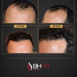 This patient underwent Follicular Unit Extraction (FUE) with 2,700 grafts, strategically placed to r