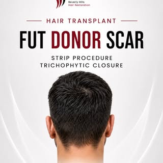 One thing I always tell patients is this: there is no such thing as a truly scar-free hair transplan