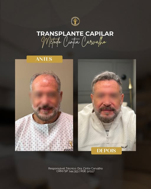 Esse paciente chegou com uma calvície bem avançada, e uma dúvida que muitos pacientes carregam: será