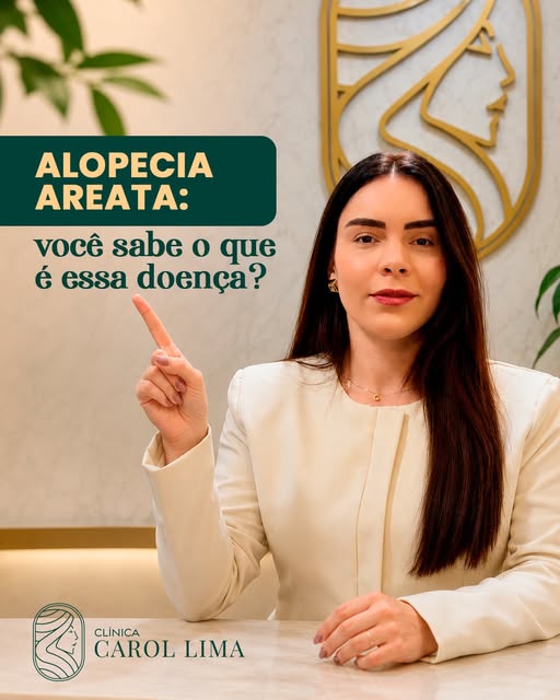 A alopecia areata é uma condição que pode provocar a queda dos cabelos em áreas bem delimitadas, for