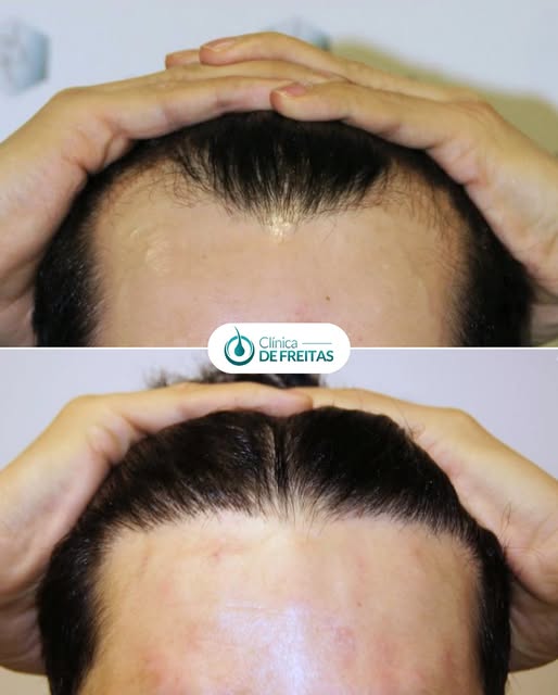 At 30 years old, this patient began to notice the first signs of androgenetic alopecia: a receding h