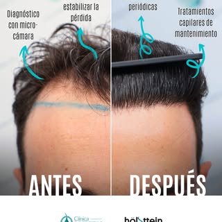 En Grupo Clínica de Freitas, cada trasplante capilar cuenta una historia. Una historia que comienza 