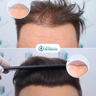Restoring confidence, one step at a time.

At just 28 years old, this patient from Spain was already