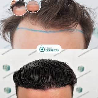 Hair Transplant Case – FUE Technique | 3,066 Grafts (8,232 Hairs)

📌 35-year-old male patient prese