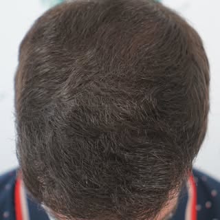 30-year-old male patient presenting with **Norwood IV diffuse alopecia**, characterized by generaliz