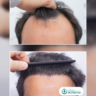 39 years old. Norwood grade II-III. Receding hairline and central area losing density.
He came to us