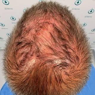 ¿Qué tipo de alopecia presenta el paciente desde el punto de vista macroscópico?