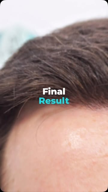 This is what a well-planned FUE hair transplant looks like — the right grafts, placed in the right d