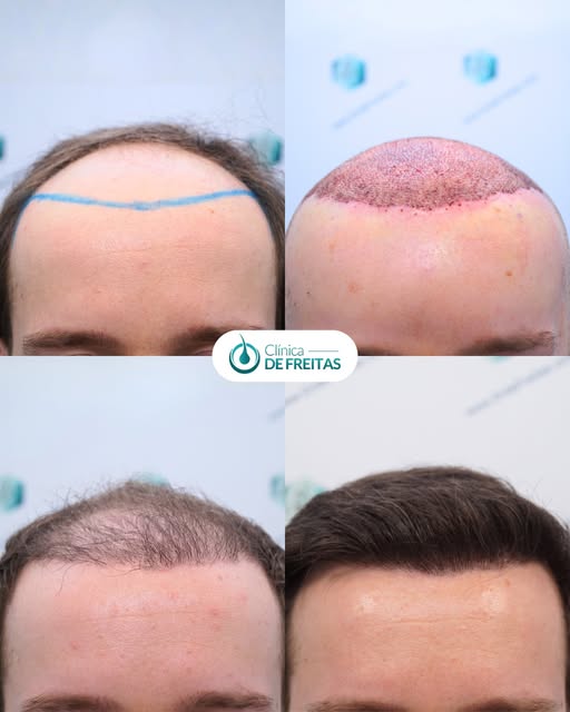 A 38-year-old male patient with Norwood III androgenetic alopecia, progressing toward a diffuse mixe