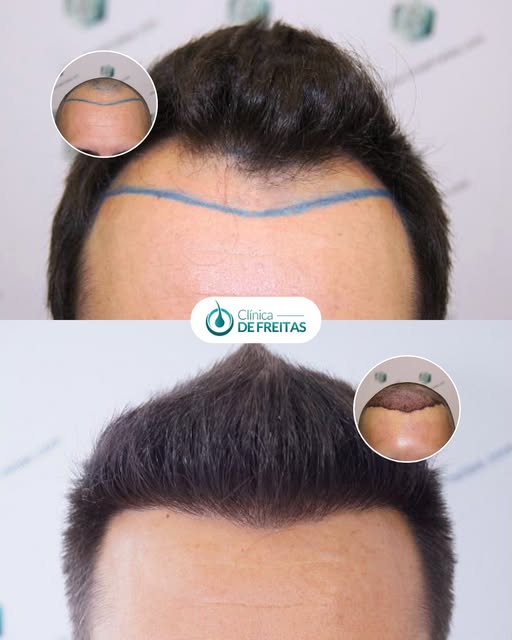 FUE Hair Transplant | Norwood IV

A 40-year-old male patient with Norwood IV androgenetic alopecia u