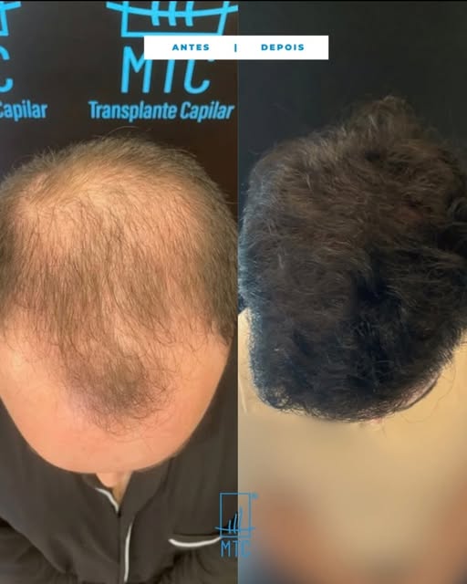 10 meses de evolução e um resultado cada vez mais natural.

O transplante capilar é um processo. O t