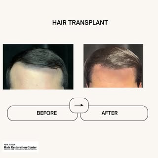 New beginnings with every strand! 😍 Witness the transformation that a hair transplant can bring. Sw
