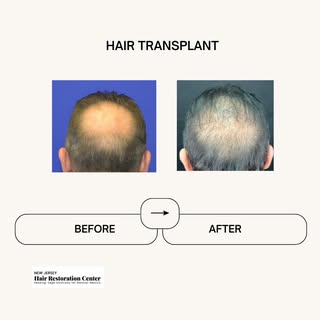 Regaining self-assurance with each hair follicle! 🌟 Witness this remarkable change in the crown sec