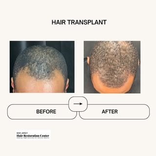 Transforming looks, boosting confidence! 🌟 A seamless hairline restoration showcasing natural and i