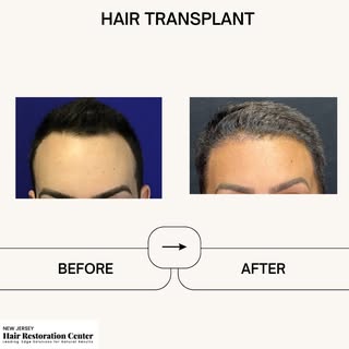 Confidence restored with a new hairline! 🌟✨ From receding to remarkable – witness the transformatio