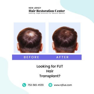 Why settle for thinning hair when you can have a full, healthy head of hair? Our FUT hair transplant