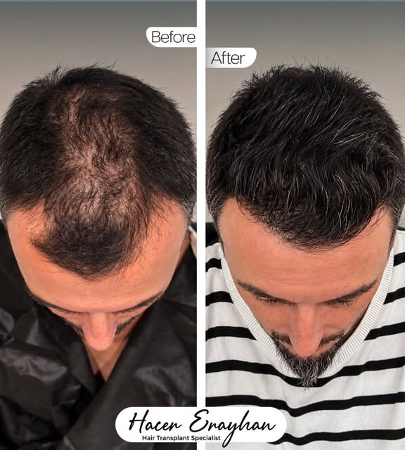 Ufak bir dokunuş tüm görseli ,ifadeyi değiştirir.Eksik olan yerine gelir 🤩Ön hattını yeni bir çizgi
