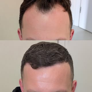3800 grafts – FUE / DHI – Hairline, frontal area & crown restoration. Photos taken 12 months after t